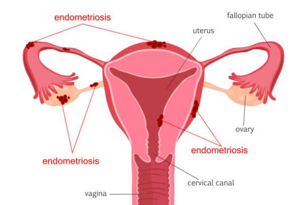 “Women” not allowed: Endometriosis Network Complicit in Female Erasure